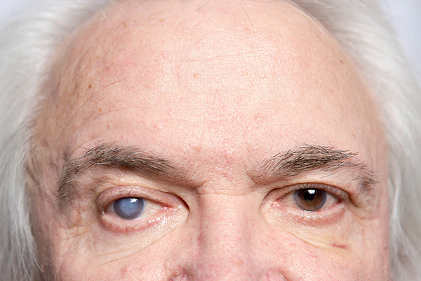 The image shows a close-up of an elderly man with two different colored eyes, highlighting the contrast between the two halves of his face.