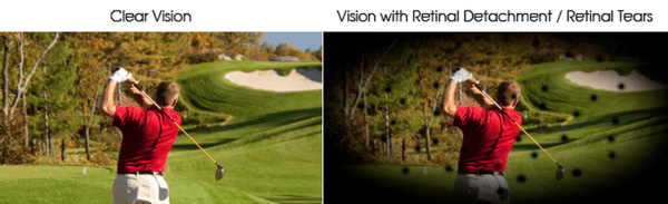 The image shows two side-by-side photographs of a golf course with a golfer in action, emphasizing the difference between vision without retinal detachment  left  and vision with retinal detachment  right , using contrasting colors to illustrate the impact on sight.