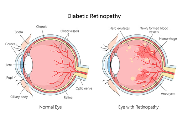 The image shows two diagrams side by side, labeled  Diabetic Retinopathy  on the left and  Retinopathy with Retinopathy  on the right. Both diagrams depict an eye with a detailed view of the retina, highlighting areas affected by diabetic retinopathy, including hemorrhages and hard exudates, as well as normal retinal structures. The left side shows a healthy retina, while the right side illustrates the progression and complications of diabetic retinopathy.