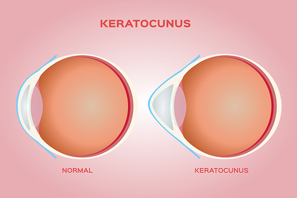 The image depicts a medical illustration of a human eye with annotations for  normal  and  Keratoconus,  which is a condition affecting the shape of the cornea.